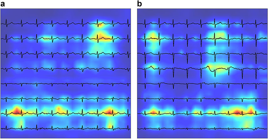 ai-powered-ecg-analysi
